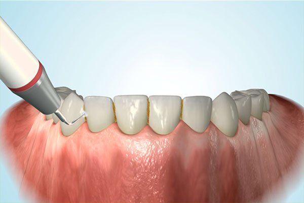 dentalhygiene Dentalhygiene bei happydens