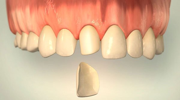 Veneer-2 Veneers aus Düsseldorf