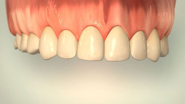 Veneer-3 Veneers aus Düsseldorf