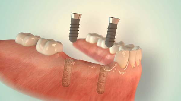 implantate-bruecke1 Zahnimplantate aus Düsseldorf