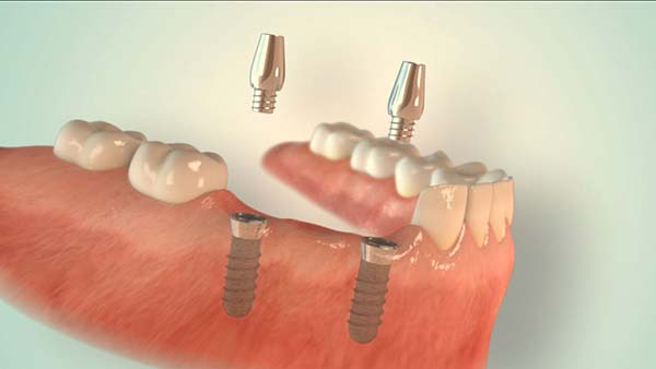 implantate-bruecke2 Implantate aus Düsseldorf