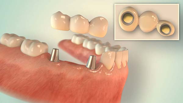 implantate-bruecke3 Implantate aus Düsseldorf