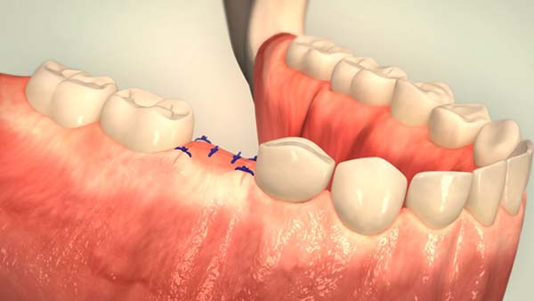 implantate3 Zahnersatz ohne Zuzahlung