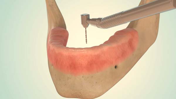 mini-implantate-1 Mini Implantate bei happydens