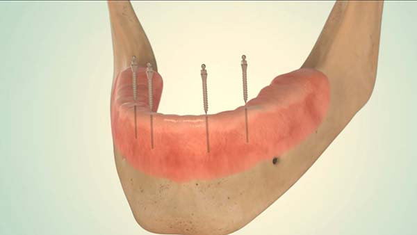 mini-implantate-2 Mini Implantate bei Ihrem Zahnarzt in Düsseldorf