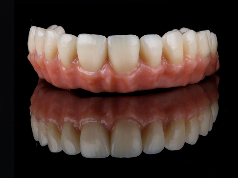 All-on-4 Zahn-Prothese für den Oberkiefer