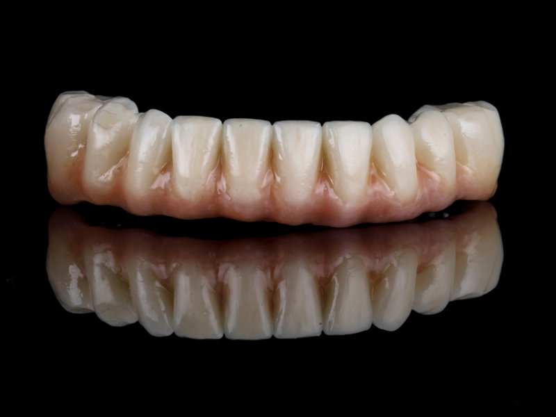 All-on-4 Zahn-Prothese für den Unterkiefer