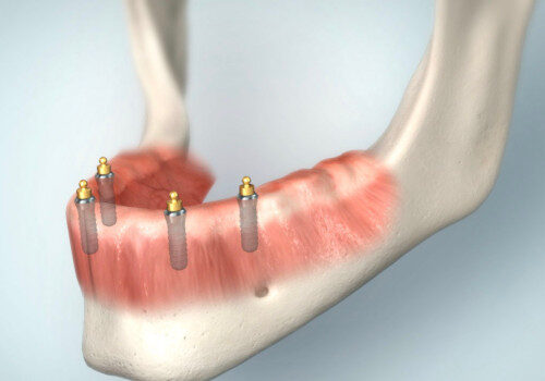 Implantate für Druckknopfprothesen im Unterkiefer