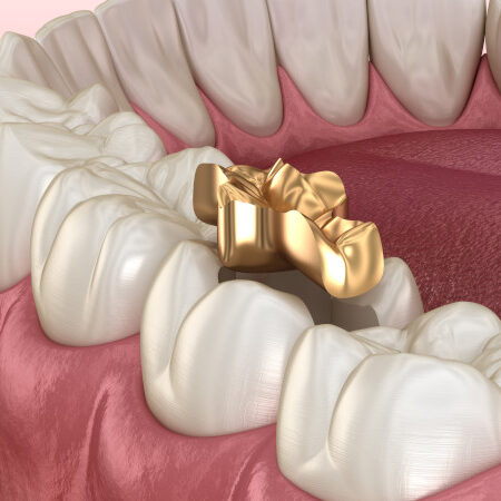 Zahn-Inlay aus Gold