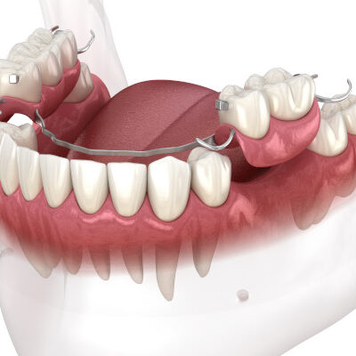 Günstiger Zahnersatz ohne Zuzahlung - herausnehmbare Zahnprothese
