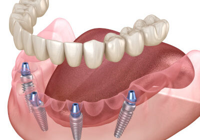 Mini-Zahnimplantat-Einsatz im Unterkiefer