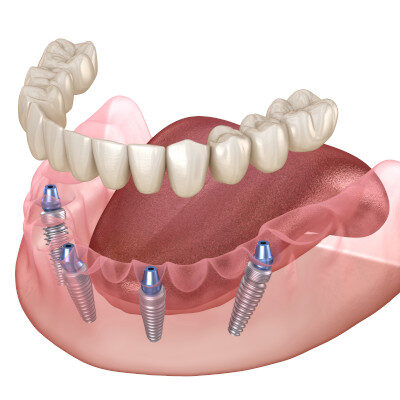 Mini-Zahnimplantat-Einsatz im Unterkiefer