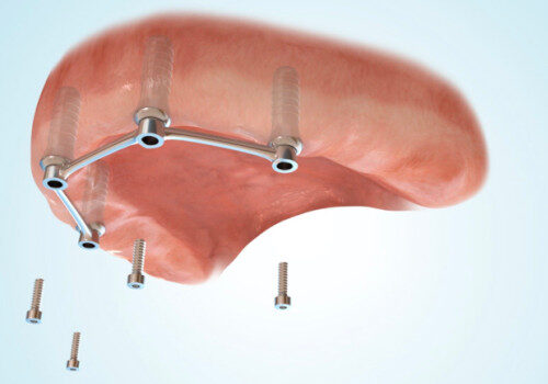 Implantate für Stegprothesen im Oberkiefer