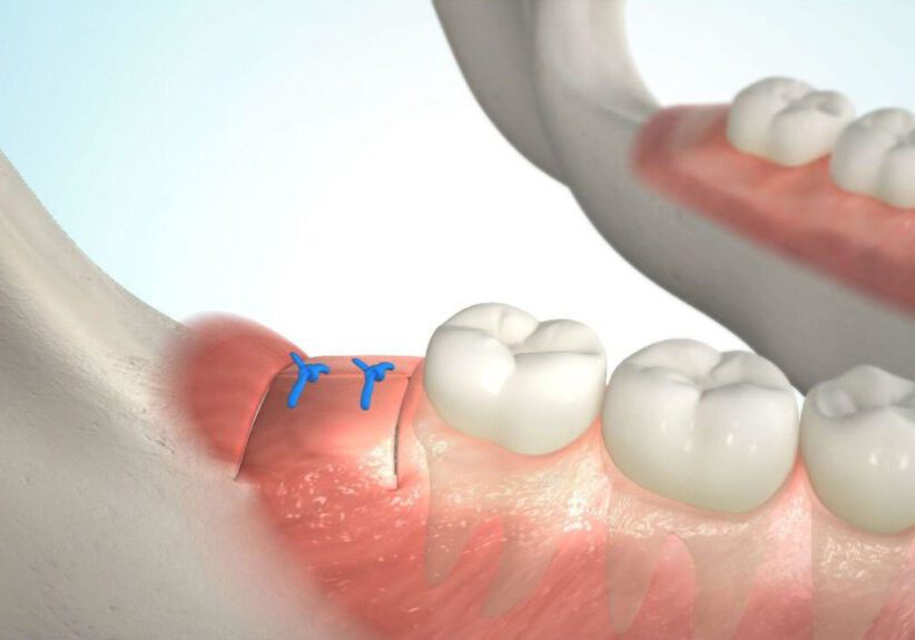 Naht nach einer Weisheitszahn-OP