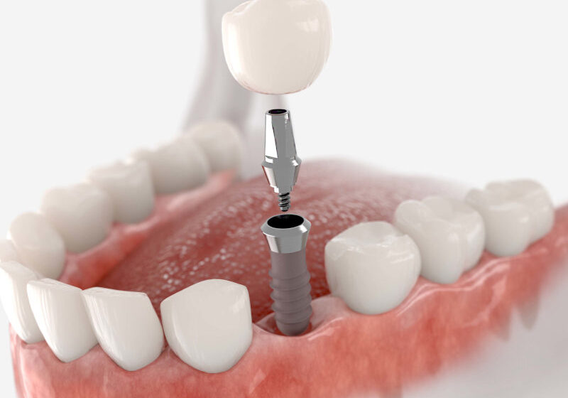 Einsatz eines Zahnimplantats im Unterkiefer