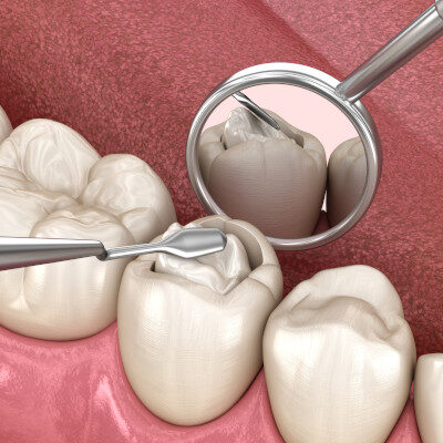 Einbettung einer zahnfarbenen Füllung in den Zahn