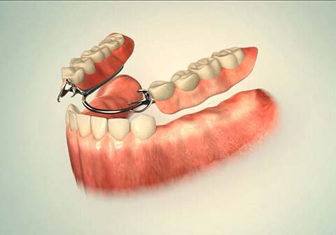 Herausnehmbarer Zahnersatz - Teilprothese für den Unterkiefer
