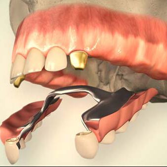 Herausnehmbarer Zahnersatz: Brückenprothese