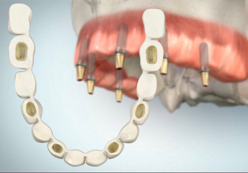 Zahnprothese ohne Gaumenplatte auf Implantaten im Oberkiefer
