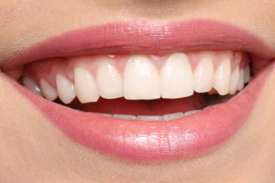 Zähne nach dem Zahn-Bleaching