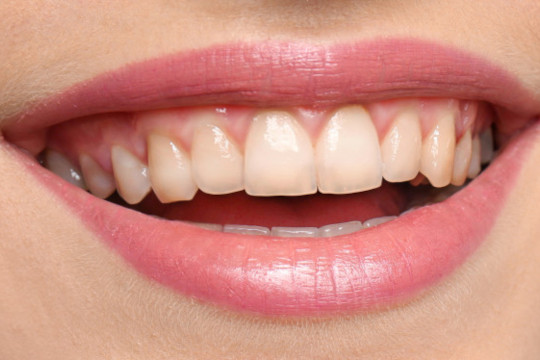 Zähne vor dem Zahn-Bleaching
