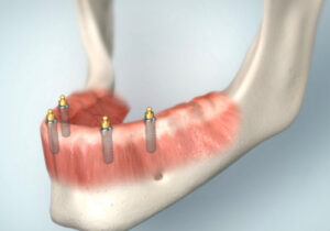 Implantate für Druckknopfprothesen im Unterkiefer