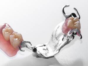 Günstiger Zahnersatz - Zahnprothesen-Beispiel 1