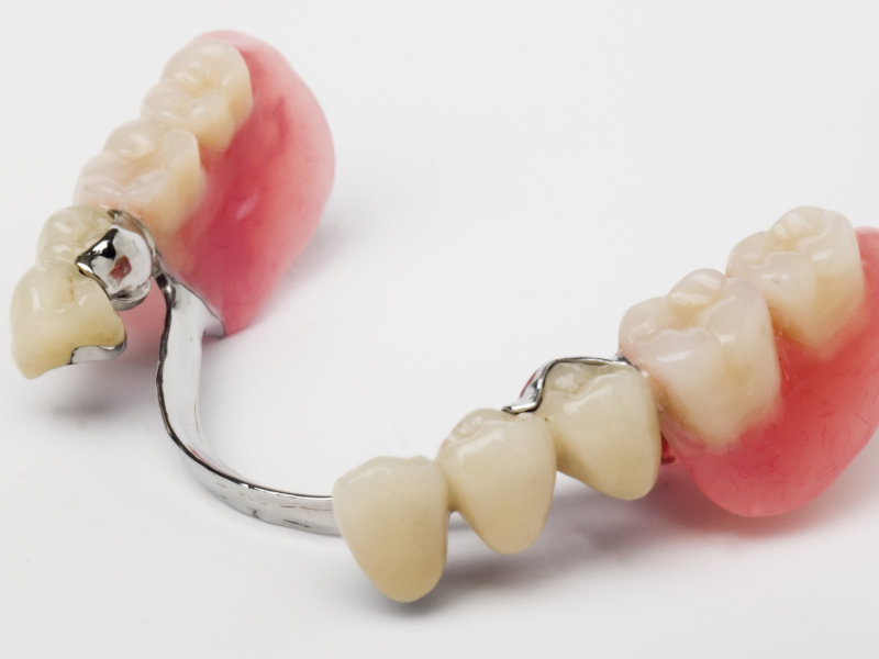 Günstiger Zahnersatz - Zahnprothesen-Beispiel 3