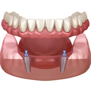 Druckknopfprothese für den Unterkiefer als Beispiel für herausnehmbaren Zahnersatz auf Implantaten