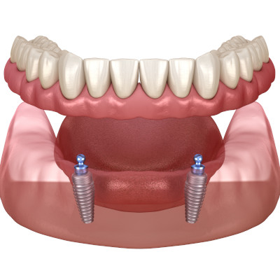 Druckknopfprothese im Unterkiefer - herausnehmbarer Zahnersatz auf Implantaten