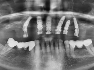 Röntgenbild von Zahnimplantaten im Kiefer