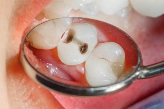 Karies-befallener Zahn vor Füllung