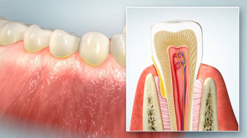 Zahnfleischentzündung durch Ablagerungen am Zahnhals