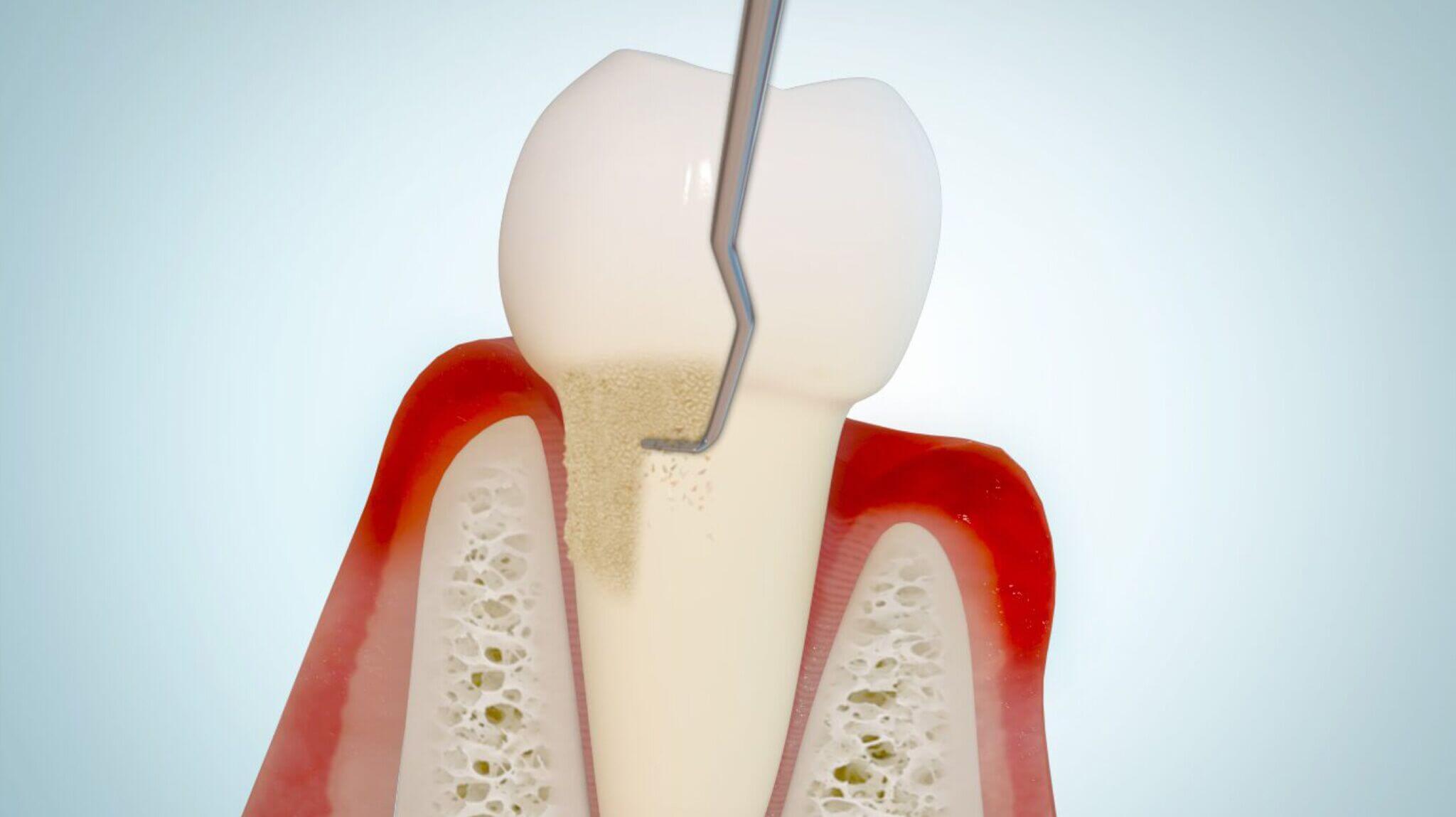 Zahnstein-Entfernung bei Parodontitis