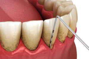 Zahnstein-Entfernung in der Parodontologie Düsseldorf