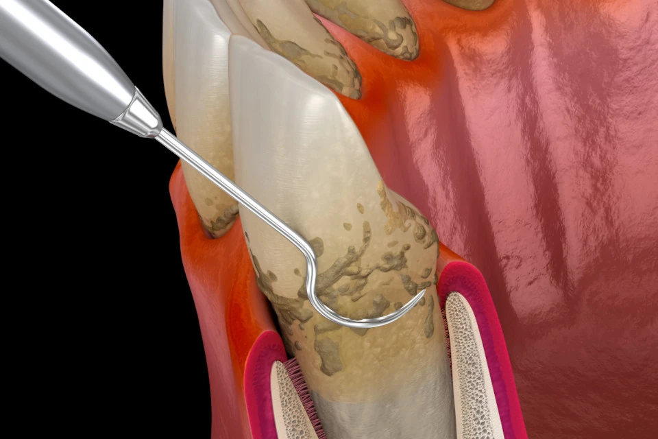 Entfernung von Zahnstein zur Behandlung von Parodontitis