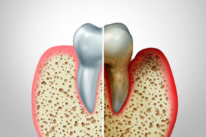 Vergleich gesunder Zahn und Zahn mit Parodontitis
