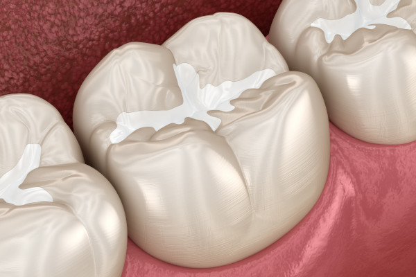 Zahn-Prophylaxe mit Zahnreinigung und Zahnversiegelung