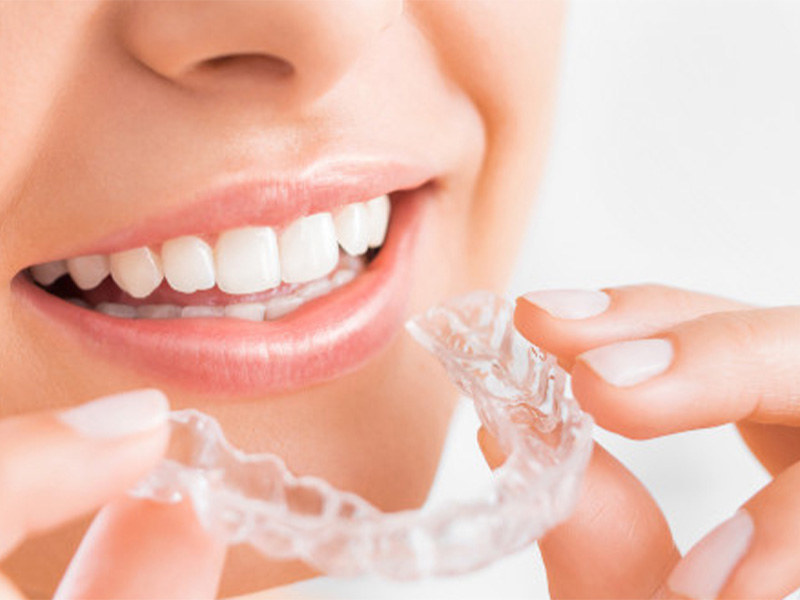 Unsichtbare Zahnspange vor lächelndem Frauenmund