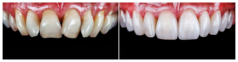 Zähne mit und ohne Veneers (vorher nachher Kundenbild)