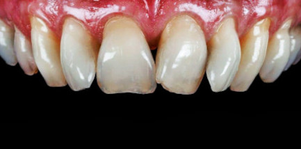 Schiefe Zähne vor Anbringung von Veneers