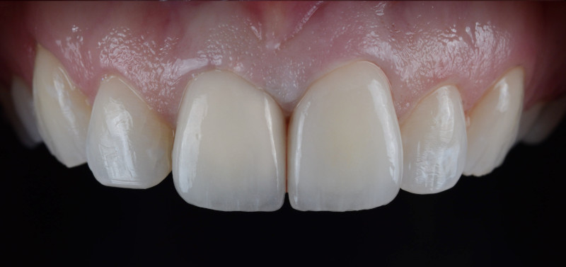 Zähne nach der Versorgung mit Vollkeramikkronen