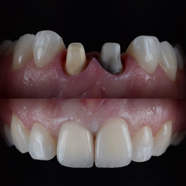 Zahnersatz aus Vollkeramik für Zahnstümpfe