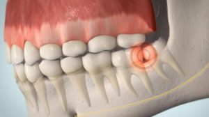 Druck des Weisheitszahns auf benachbarte Zähne