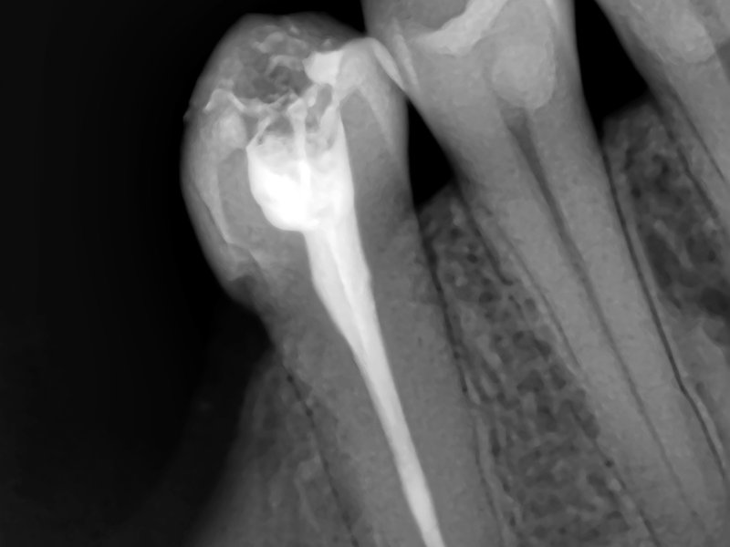Röntgenbild vor einer Wurzelbehandlung beim Zahnarzt