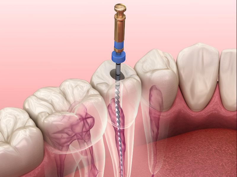 Wurzelbehandlung beim Zahnarzt in Düsseldorf