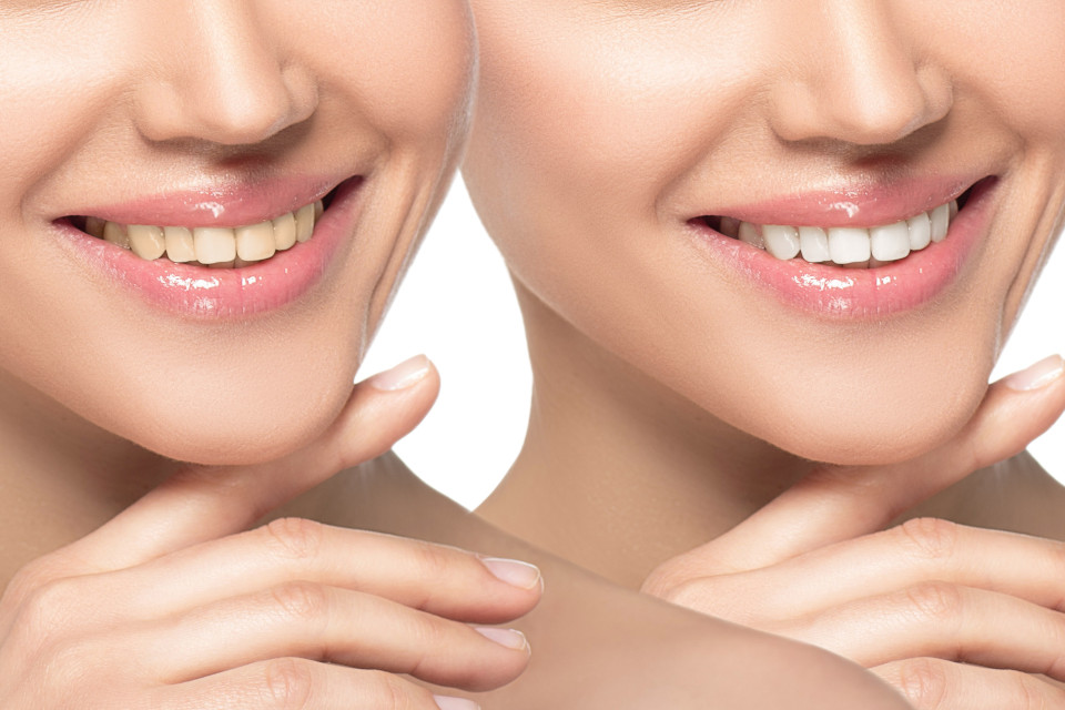 Zahn-Bleaching - Frauenlächeln vorher und nachher