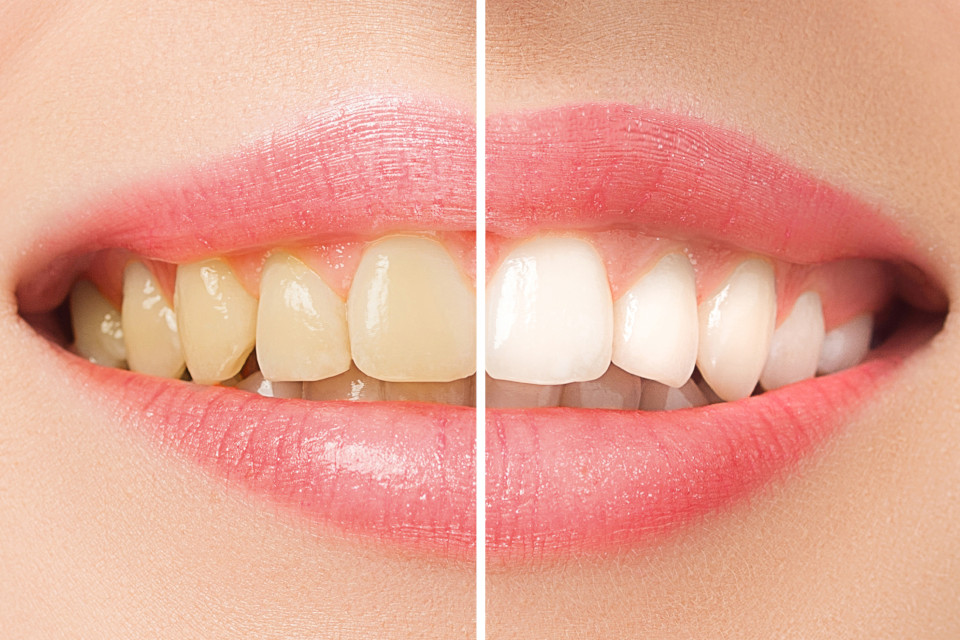 Zahn-Bleaching Kunden-Erfahrung vorher und nachher