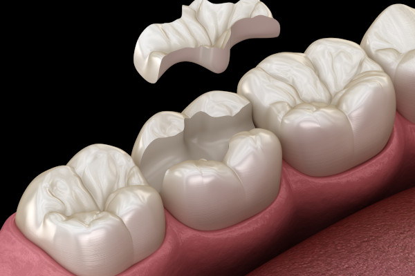 Zahnerhaltung: Inlay-Einsatz nach Kariesbehandlung