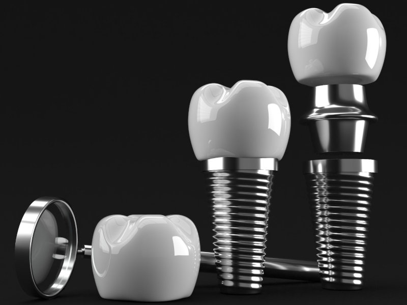 Aufbau von Zahnimplantaten: Titanschraube und Keramik-Krone